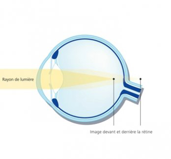 Espace Nouvelle Vision : Oeil astigmate