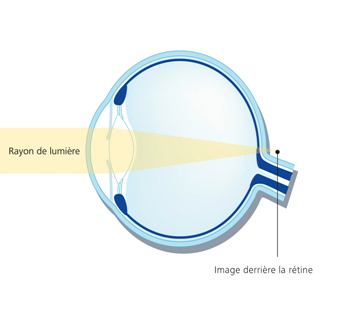 Espace Nouvelle Vision : Oeil hypermetrope