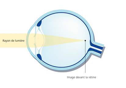 Espace Nouvelle Vision : Myopic eye